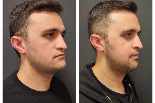 double jaw surgery